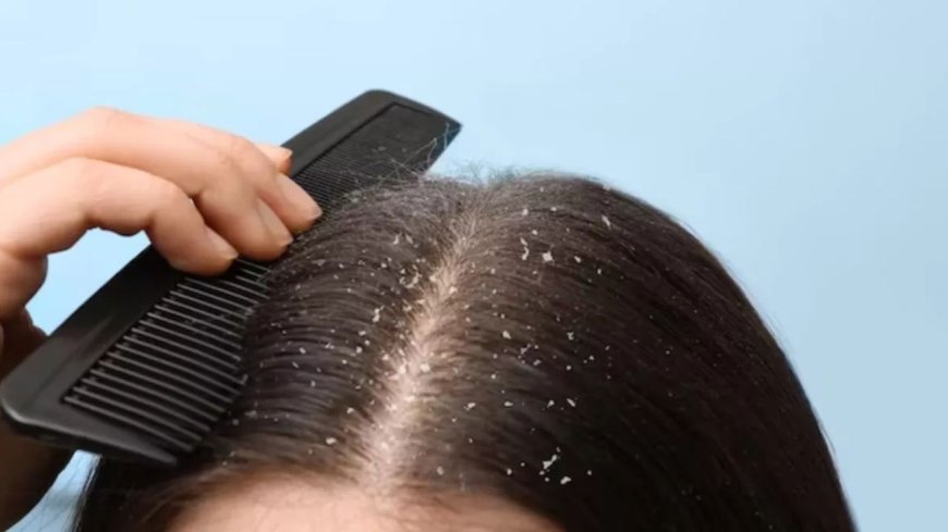 Winter Hair Care: सर्दियों में डैंड्रफ और बाल झड़ने से छुटकारा पाने के 4 आसान घरेलू नुस्खे