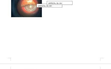 "नेत्रदान से मिली रोशनी सिम्स में हुआ कॉर्निया  प्रत्यारोपण का सफल ऑपरेशन,छत्तीसगढ़ आयुर्विज्ञान संस्थान (सिम्स),सिम्स के नेत्र रोग विभाग में चार मरीजों का सफल कॉर्निया प्रत्यारोपण,धान की बाली से जख्मी आंखों में फिर लौटी रोशनी